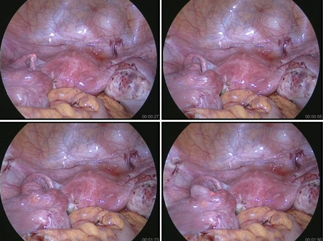 （4）卵管鏡が卵管内を通過している画像（腹腔鏡併用FT）